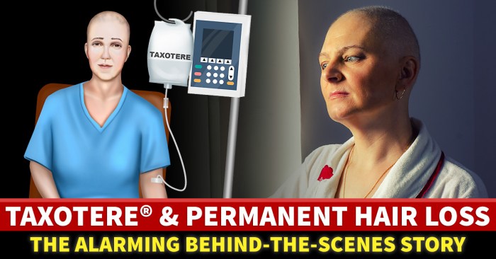 Taxotere Lawsuits For Permanent Hair Loss